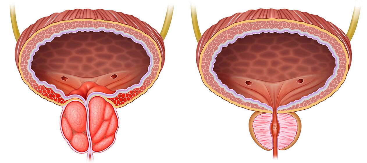 Ontstoken en gezonde prostaat na het gebruik van predstonorm capsules