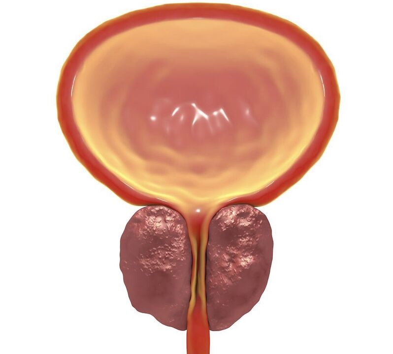 ontsteking van chronische prostatitis