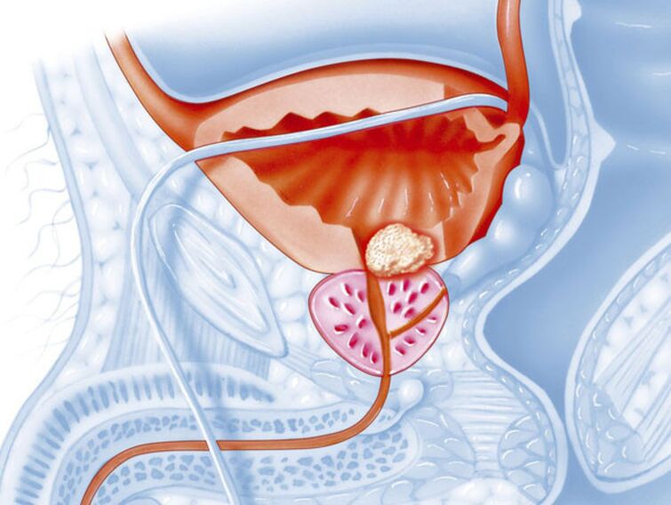 symptomen van chronische prostatitis