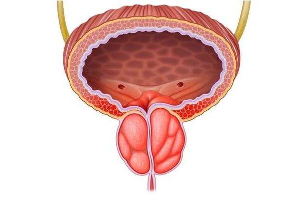 behandeling van prostatitis bij mannen