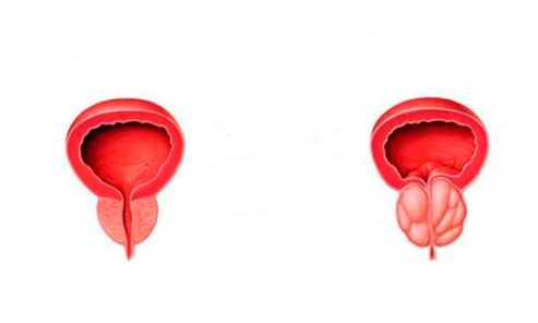 gezonde en ontstoken prostaat met prostatitis